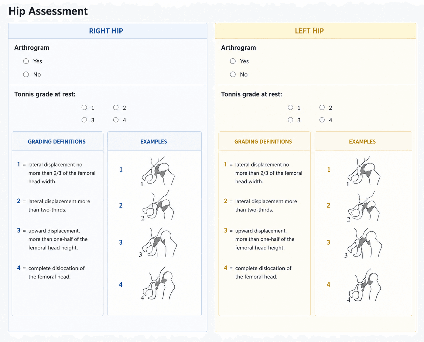 Hip assessment form with right and left hip panels. Beneath the Tonnis grade at rest radio buttons, each panel shows a grading definitions block listing grades 1 to 4 and an examples block with matching line drawings of the femoral head.